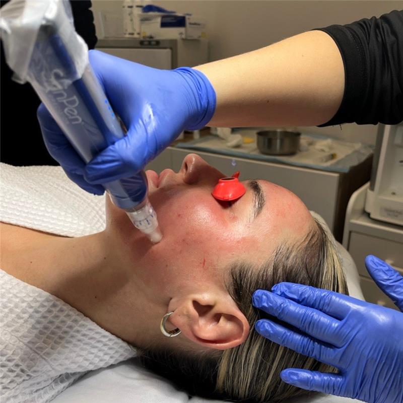 EXCLUSIVE: Package of 3 Microneedling Face Treatments + ZO Accelerating Serums