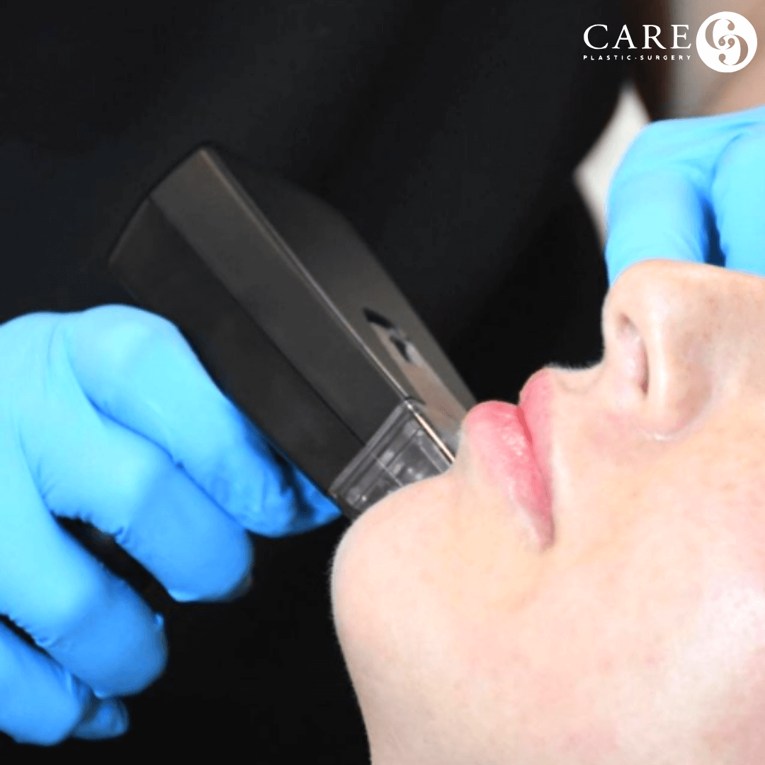 Morpheus8 With PRP for Face (Package of 3 treatments)