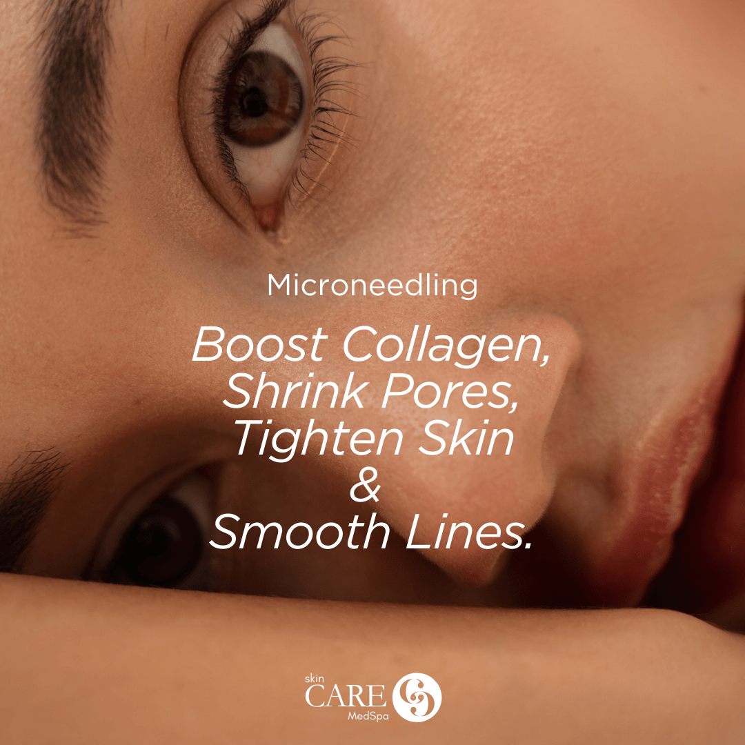EXCLUSIVE: Package of 3 Microneedling Face Treatments + ZO Accelerating Serums