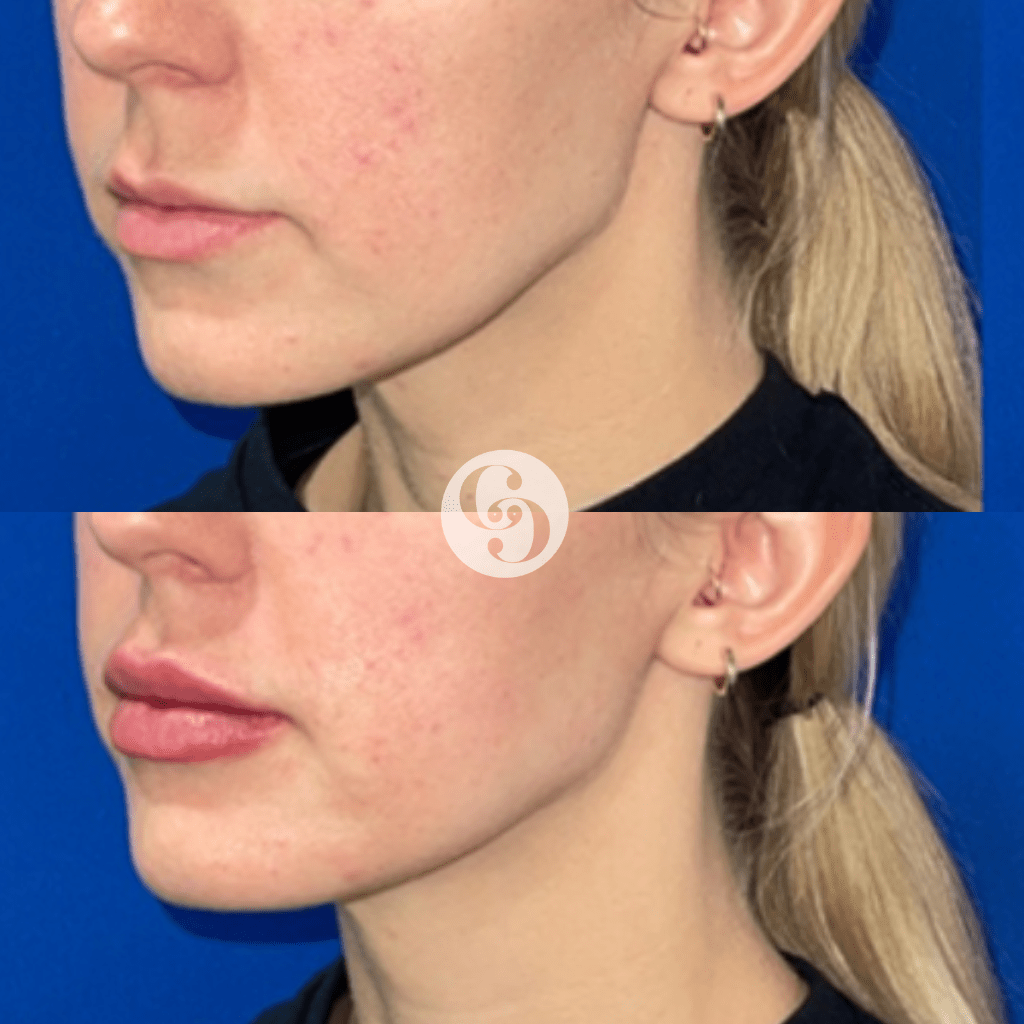 JUVÉDERM® VOLBELLA® with a complimentary lip flip