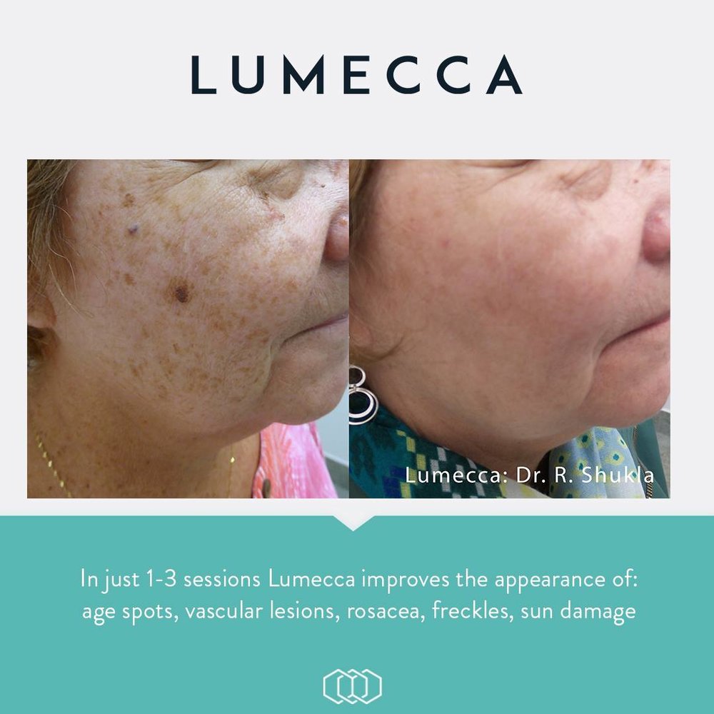 LUMECCA™ Package of 4 treatments