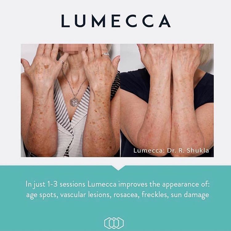 LUMECCA™ Package of 4 treatments