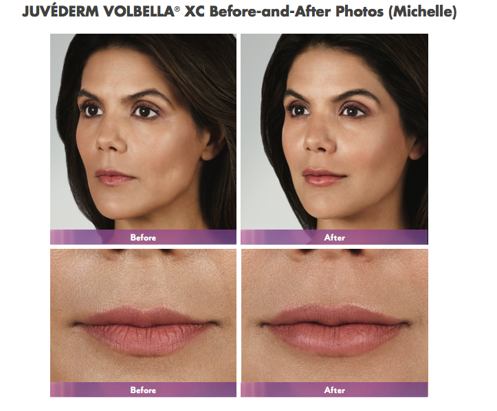 JUVÉDERM® VOLBELLA® with a complimentary lip flip