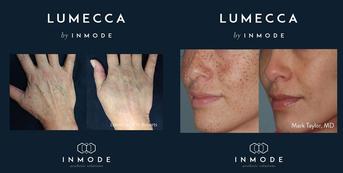 LUMECCA™ Package of 4 treatments